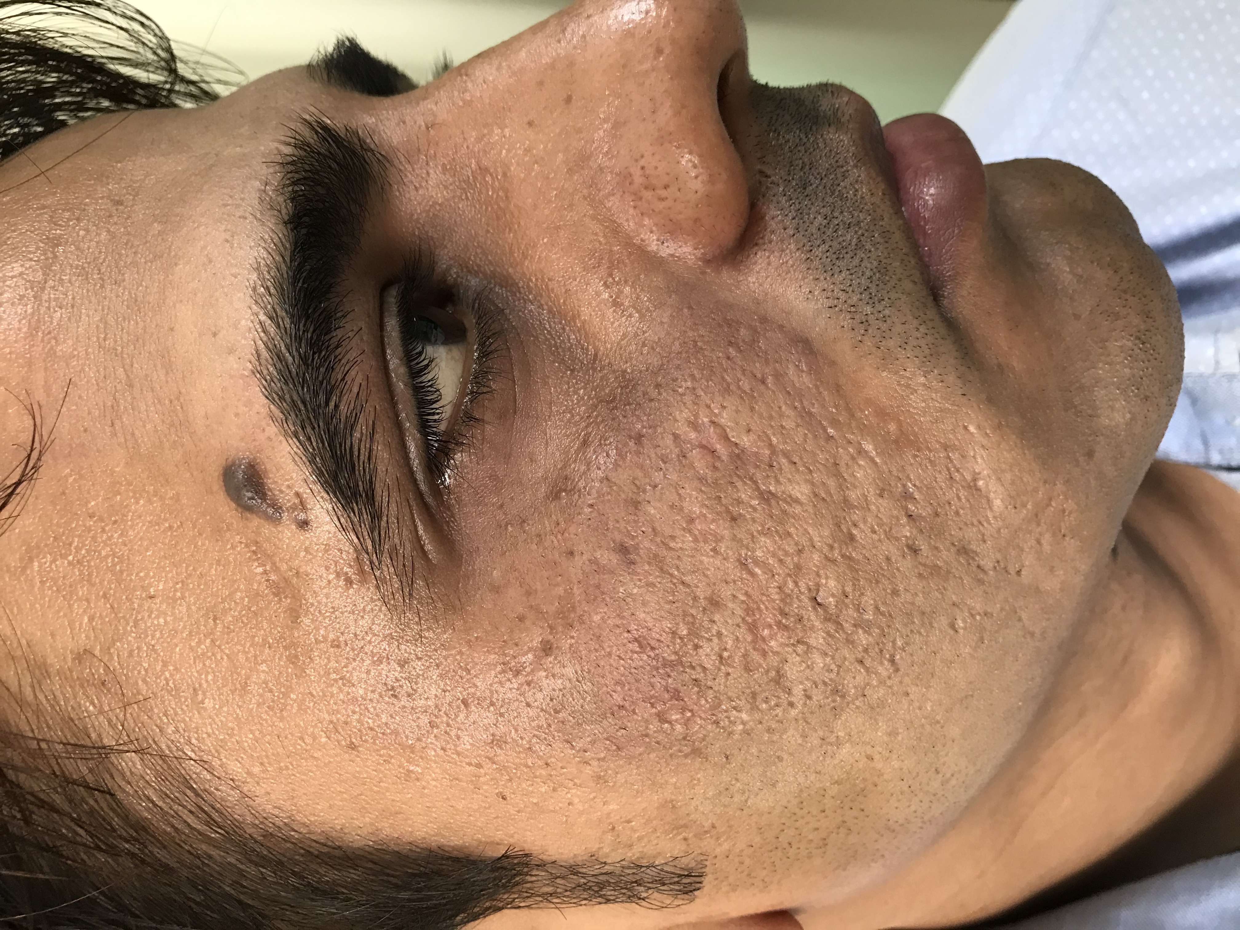 Acne Scar