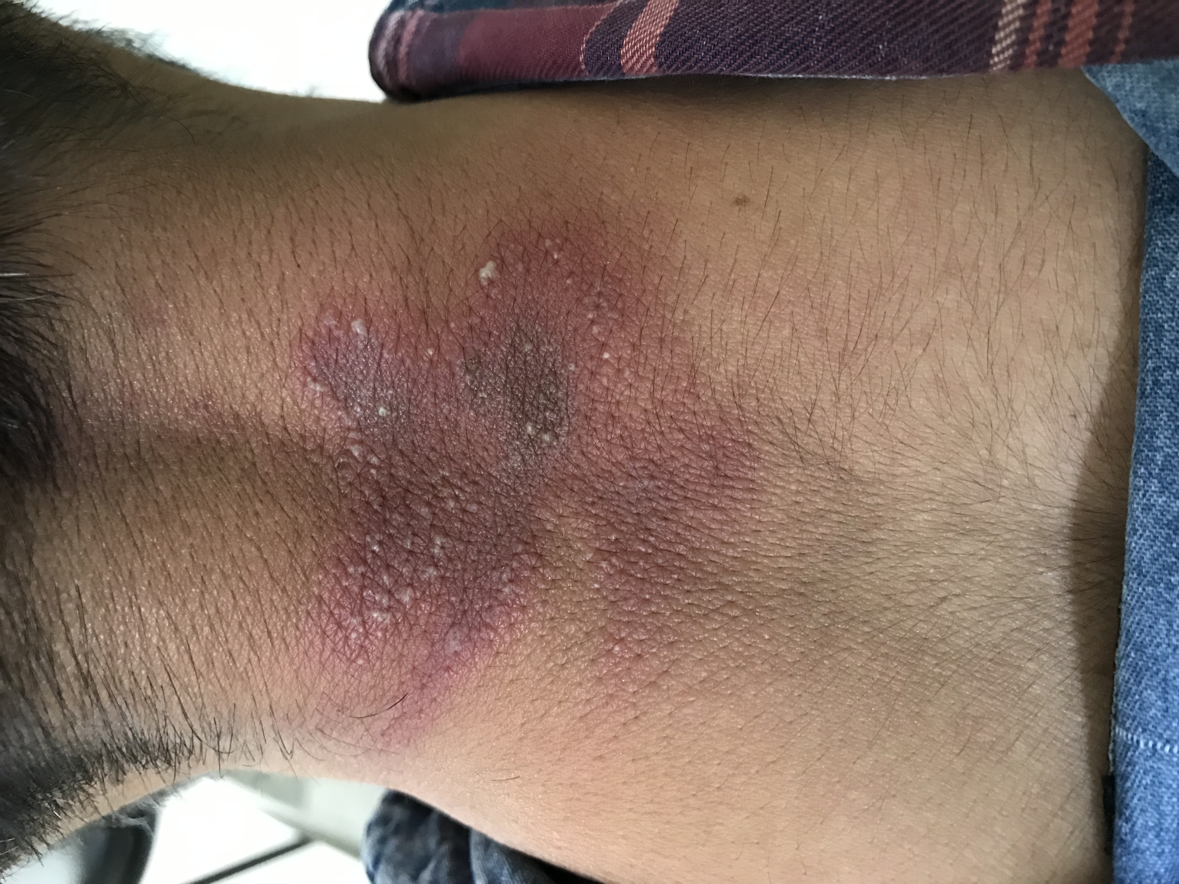 Skin Allergy