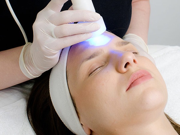 Melasma