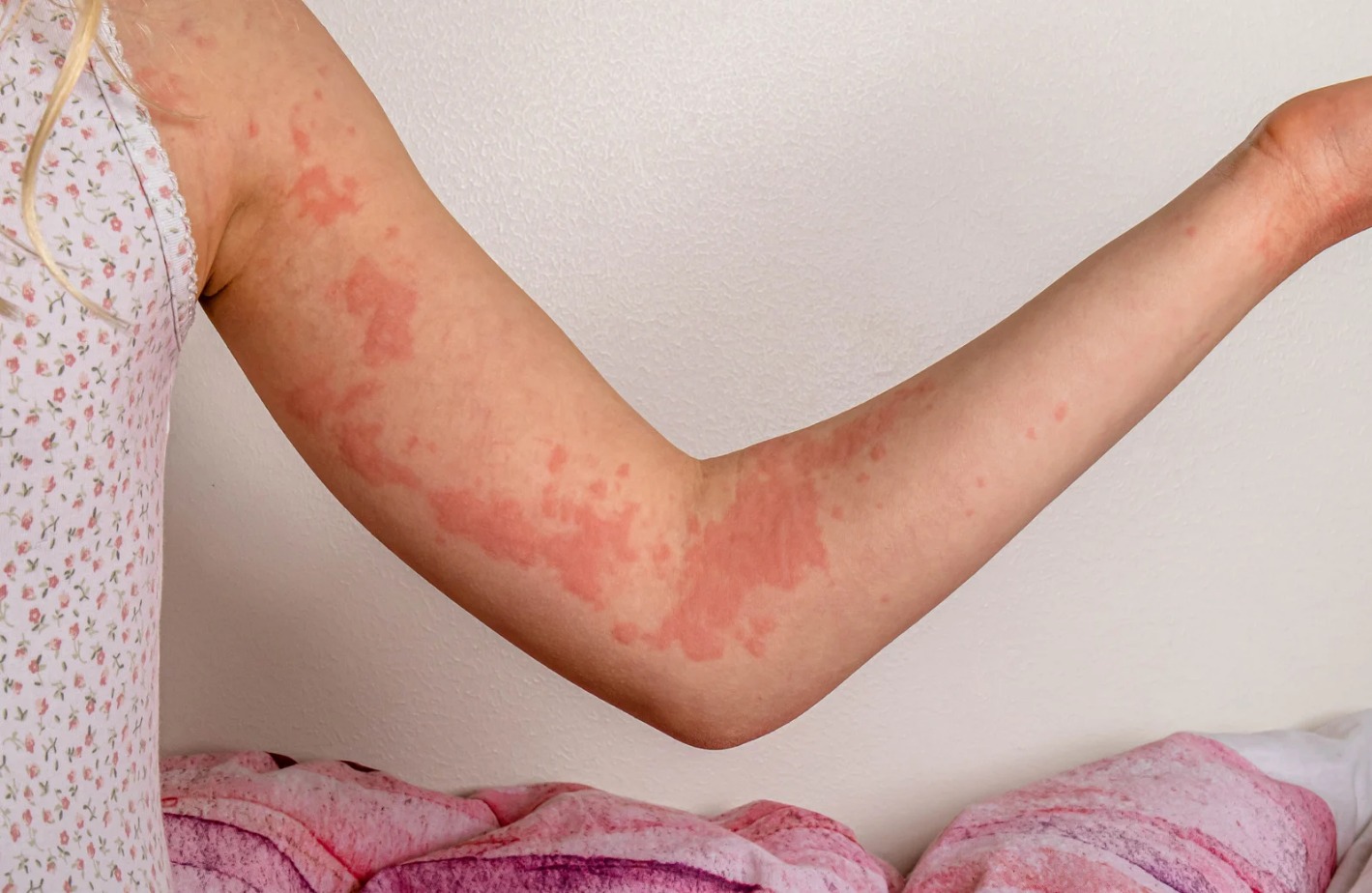 Urticaria (Hives)