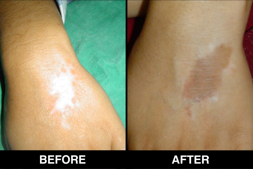 White Spots (Vitiligo)