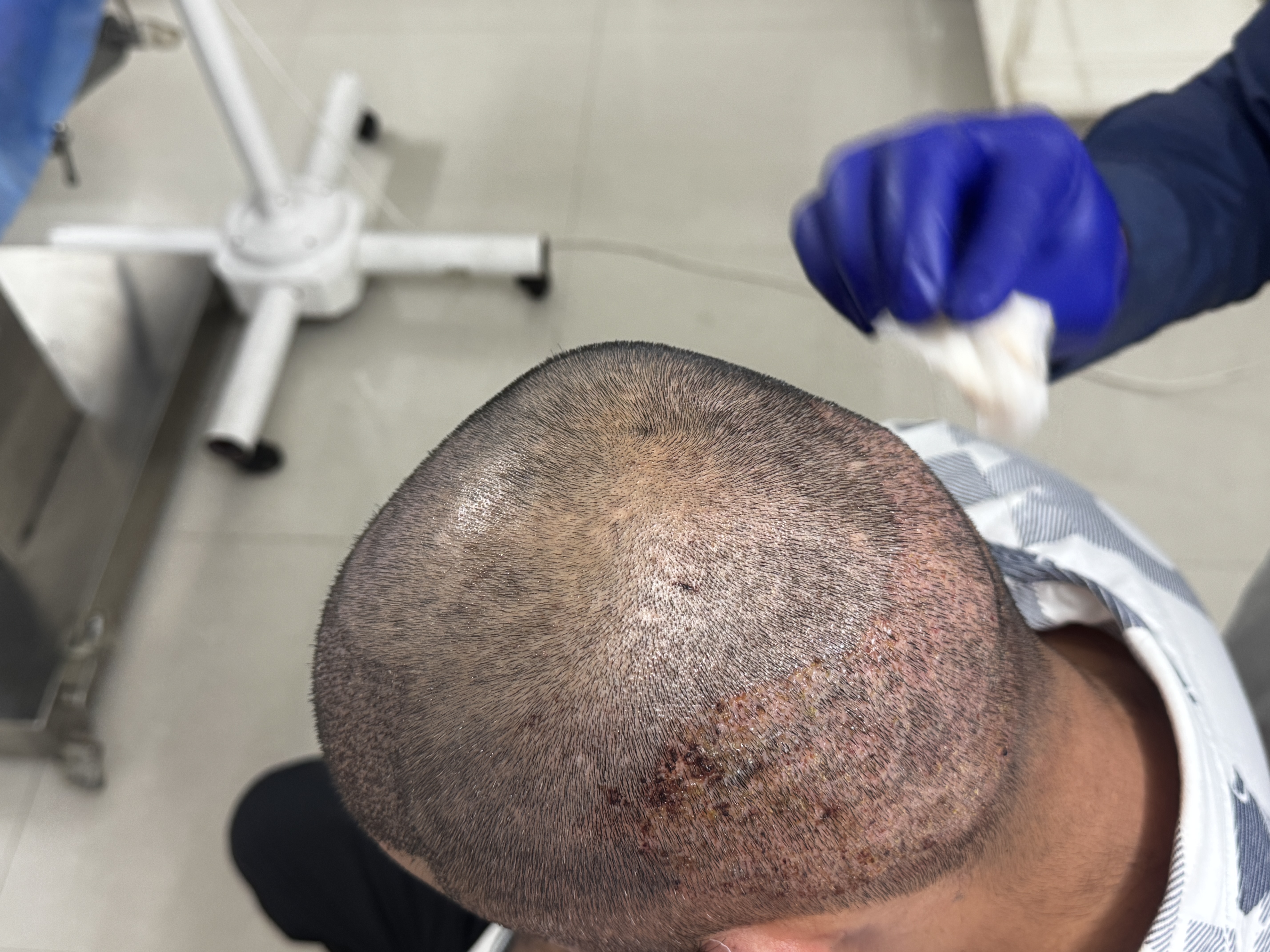 After hair transplant