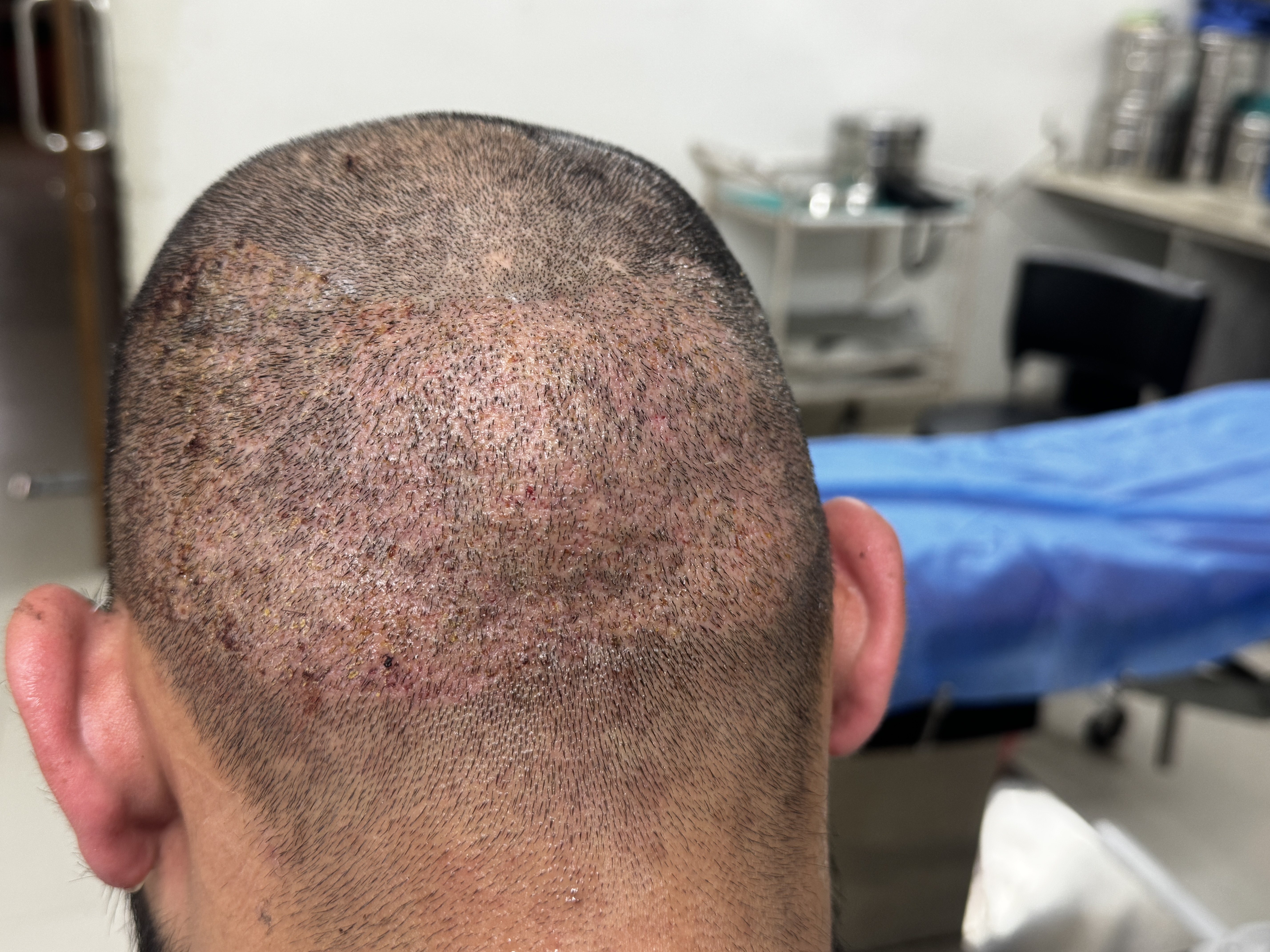 After Grade 5 baldness — full coverage with natural density