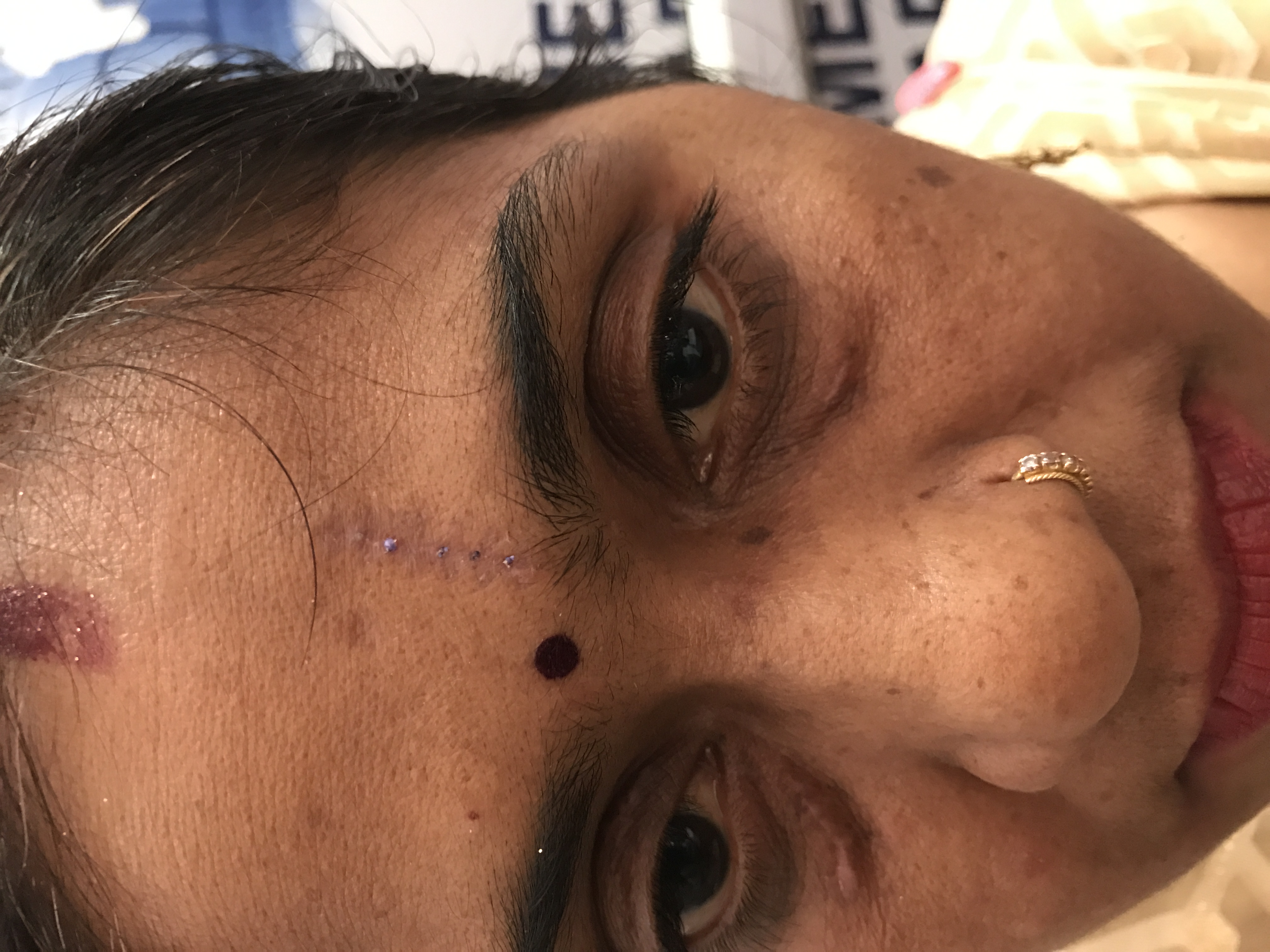 After scar revision
