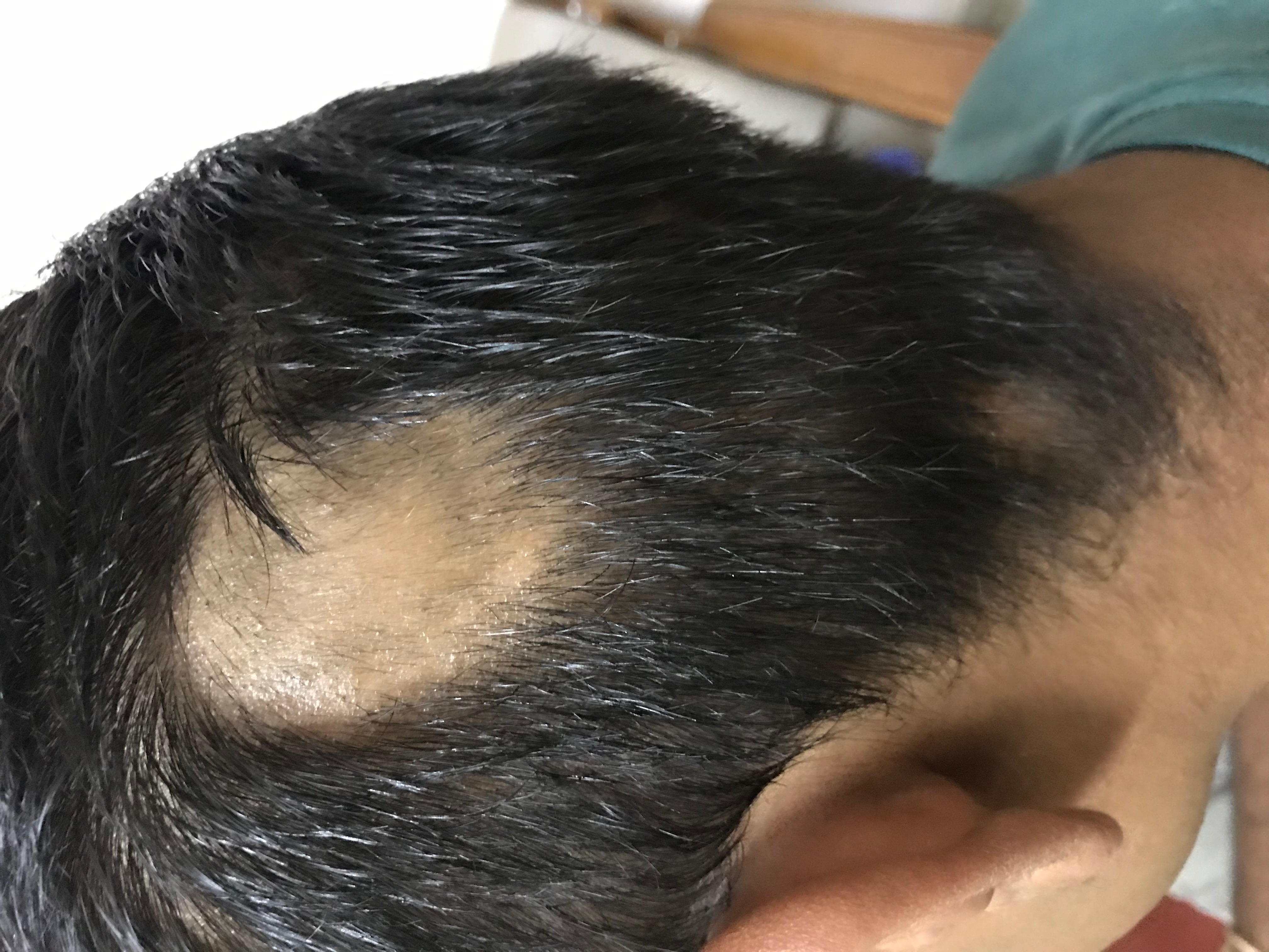 After wart removal