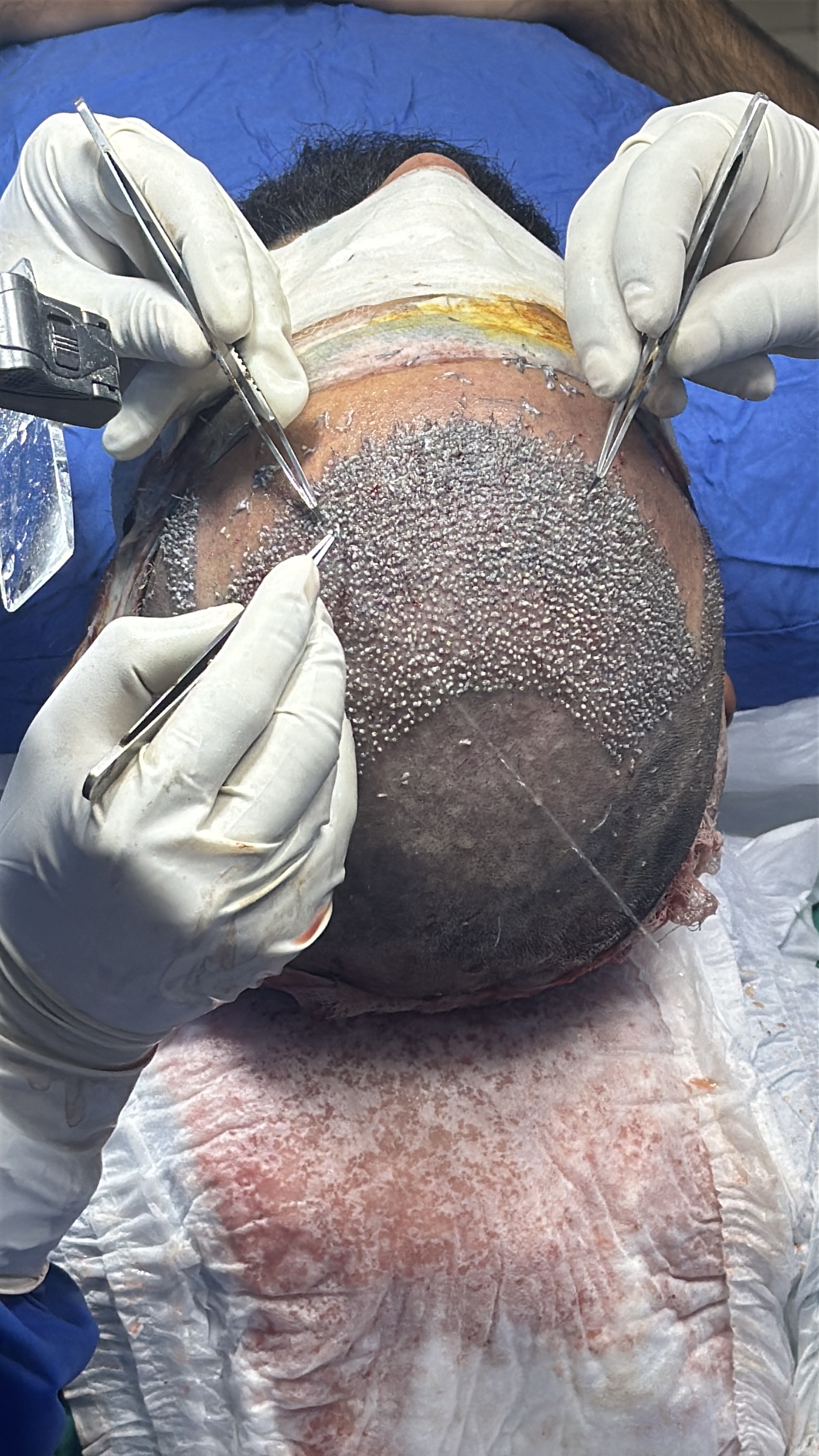 Before hair transplant