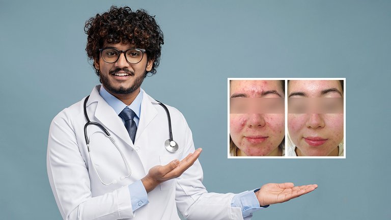 Derma Roller Treatment in Jaipur: Benefits & Sessions