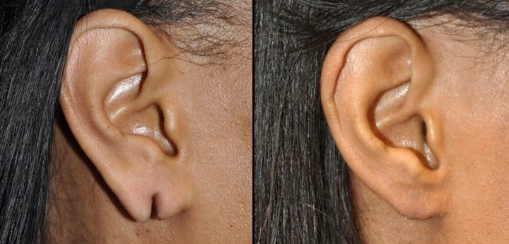Earlobe Repair Treatment in Jaipur