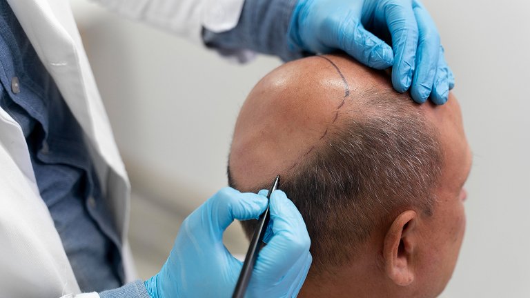 PRP Hair Treatment in Jaipur: Is It Effective?