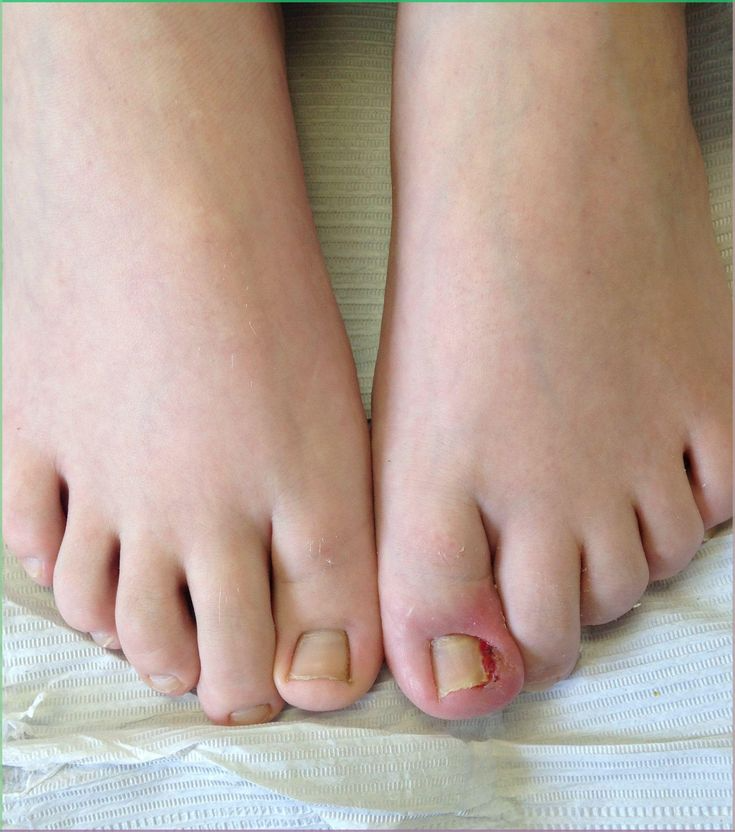 Ingrown Toenail Correction in Jaipur