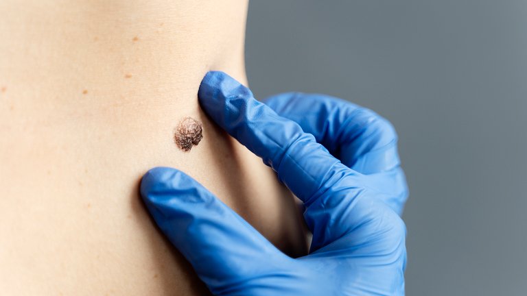 Mole & Wart Removal Treatment in Jaipur
