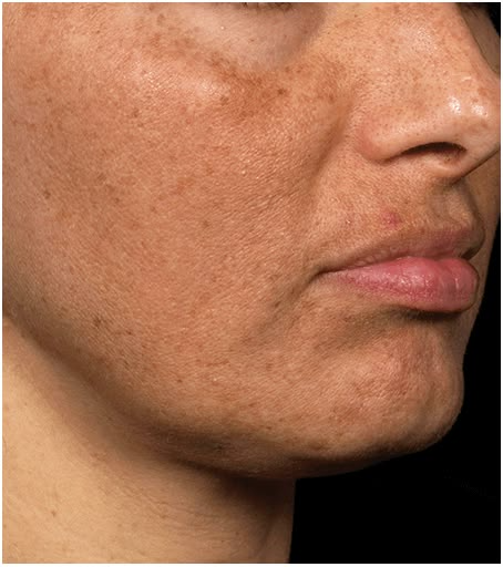 Pigmentation Treatment in Jaipur