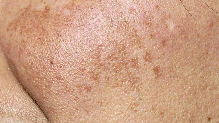 Pigmentation: Causes and Treatments
