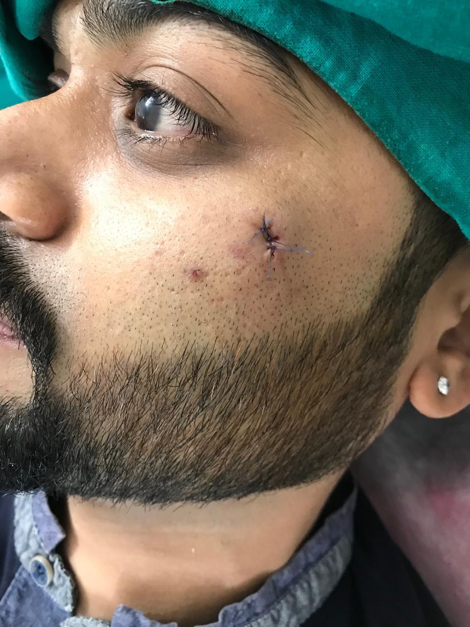 Tattoo Removal