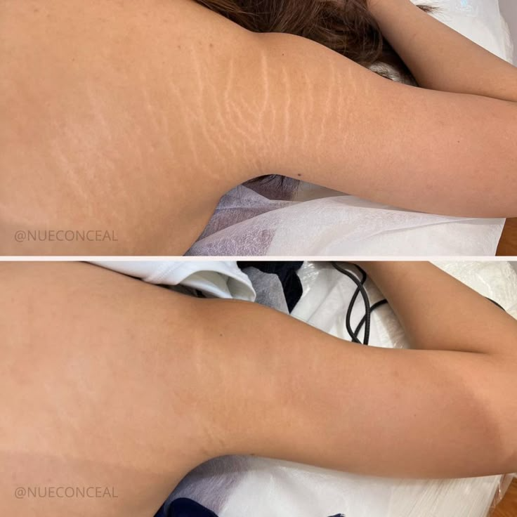 Scar Removal