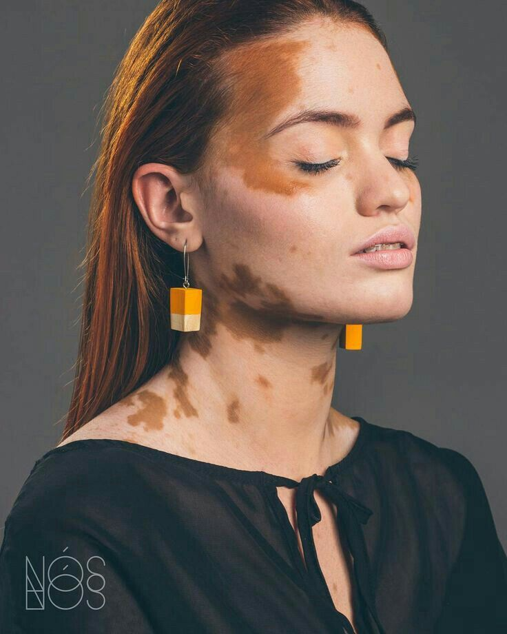 Vitiligo Surgery in Jaipur