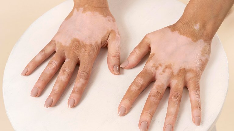 Vitiligo Treatment in Jaipur at Dermacian