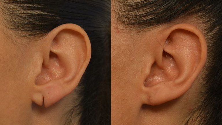 Earlobe repair