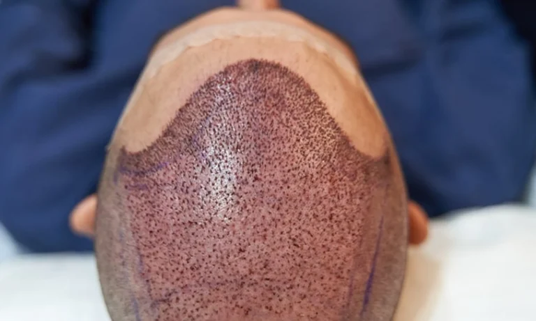 A bald scalp showing newly transplanted hair grafts after a hair transplant procedure, highlighting FUE or FUT technique results.
