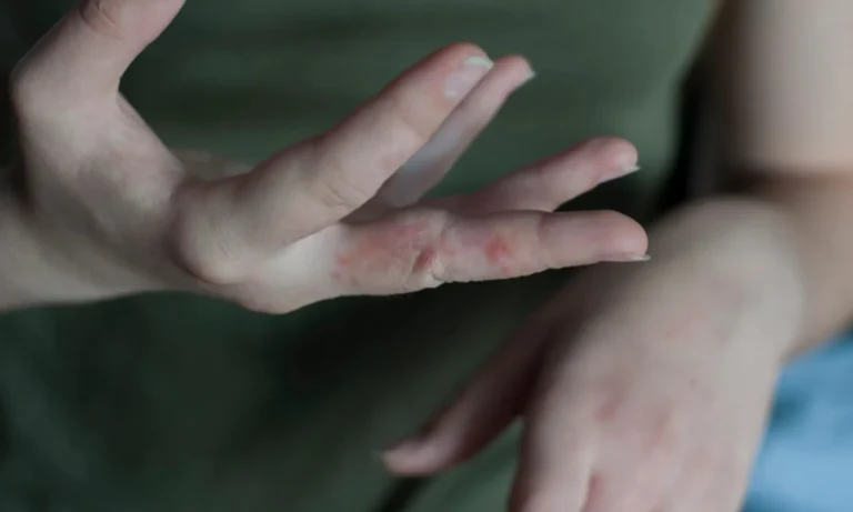 A hand with visible red patches and scaling on the fingers, showing symptoms of a fungal skin infection.