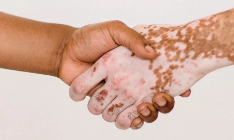 Close-up of two hands shaking, one with vitiligo patches on the skin, symbolizing skin condition awareness and acceptance.