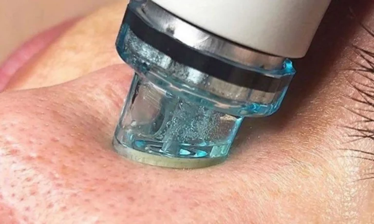 A Hydrafacial device exfoliating and hydrating facial skin during a skincare treatment.