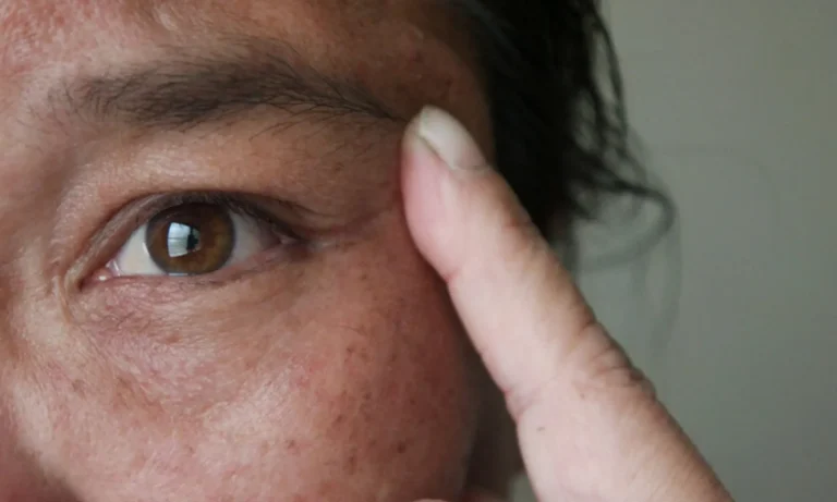 Detailed close-up of a person’s eye area showing visible skin pigmentation, dark spots, and uneven tone, with a finger pointing to the affected region.